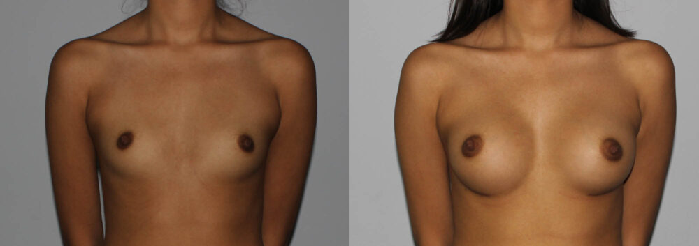 Breast Augmentation case #5640
