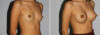 Breast Augmentation case #5640 slider thumbnail