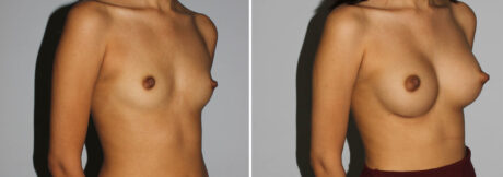 Breast Augmentation case #5640