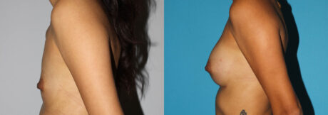 Breast Augmentation case #5618