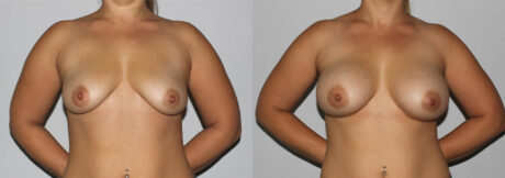 Breast Augmentation case #5607