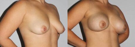 Breast Augmentation case #5607