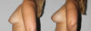 Breast Augmentation case #5607 slider thumbnail