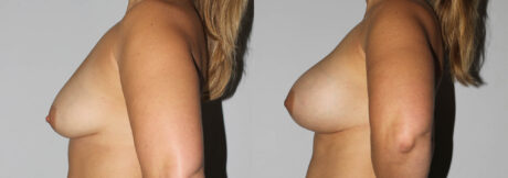 Breast Augmentation case #5607