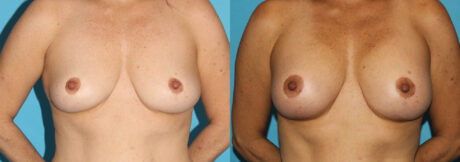 Breast Augmentation case #5603