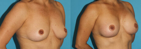Breast Augmentation case #5603