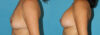 Breast Augmentation case #5603 slider thumbnail