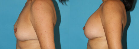 Breast Augmentation case #5603