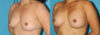 Breast Augmentation case #5603 slider thumbnail