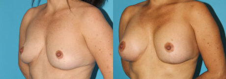 Breast Augmentation case #5603