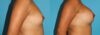 Breast Augmentation case #5659 slider thumbnail