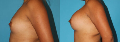 Breast Augmentation case #5659