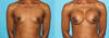 Breast Augmentation case #5666 slider thumbnail