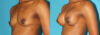Breast Augmentation case #5666 slider thumbnail
