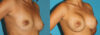 Breast Augmentation case #5653 slider thumbnail
