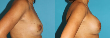Breast Augmentation case #5653