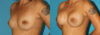 Breast Augmentation case #5653 slider thumbnail