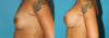 Breast Augmentation case #5653 slider thumbnail