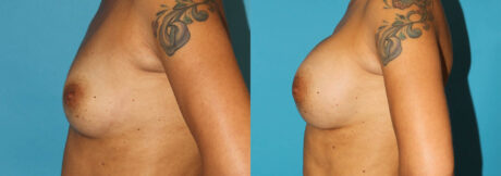 Breast Augmentation case #5653