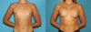 Breast Augmentation case #5626 slider thumbnail