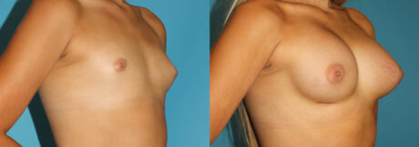Breast Augmentation case #5626