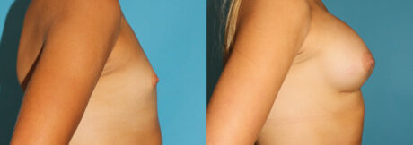 Breast Augmentation case #5626