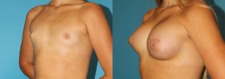 Breast Augmentation case #5626