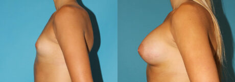 Breast Augmentation case #5626
