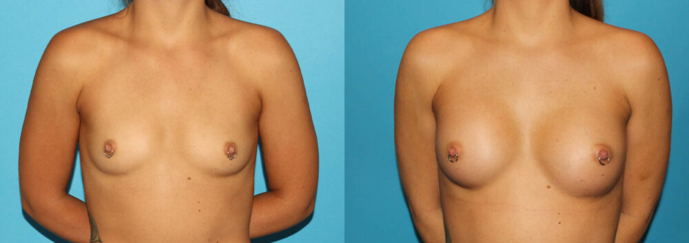 Breast Augmentation case #5672