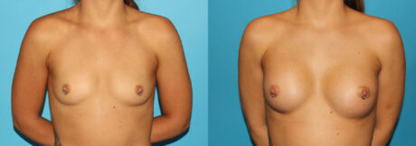 Breast Augmentation case #5672