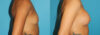 Breast Augmentation case #5672 slider thumbnail