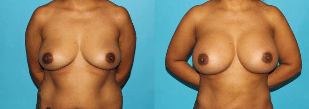 Breast Augmentation case #5678