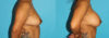 Breast Augmentation case #5678 slider thumbnail