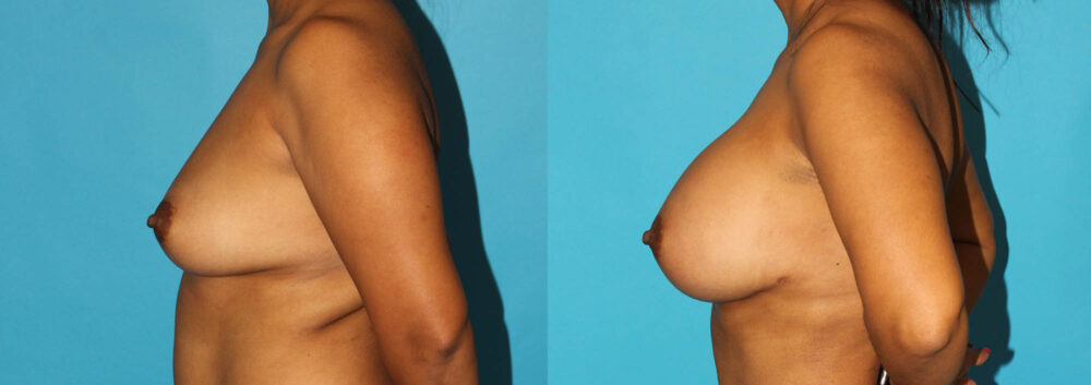 Breast Augmentation case #5678