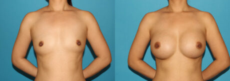 Breast Augmentation case #6250