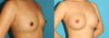 Breast Augmentation case #6250 slider thumbnail