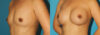 Breast Augmentation case #6250 slider thumbnail