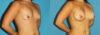Breast Augmentation case #5632 slider thumbnail