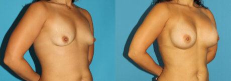 Breast Augmentation case #5632