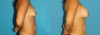 Breast Augmentation case #5632 slider thumbnail