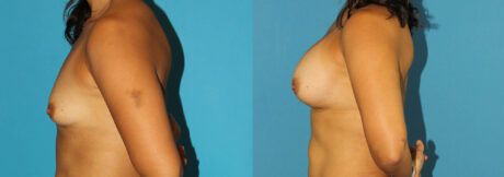 Breast Augmentation case #5632