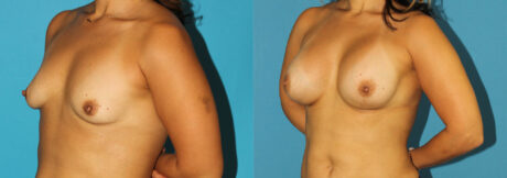 Breast Augmentation case #5632