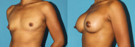 Breast Augmentation case #6256
