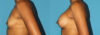 Breast Augmentation case #6256 slider thumbnail