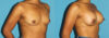 Breast Augmentation case #6256 slider thumbnail