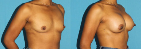 Breast Augmentation case #6256