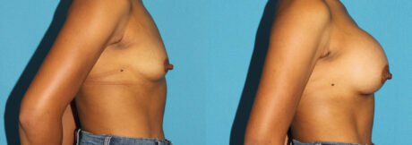Breast Augmentation case #6256