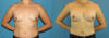 Breast Augmentation case #6262 slider thumbnail
