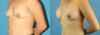 Breast Augmentation case #6262 slider thumbnail