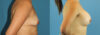Breast Augmentation case #6262 slider thumbnail
